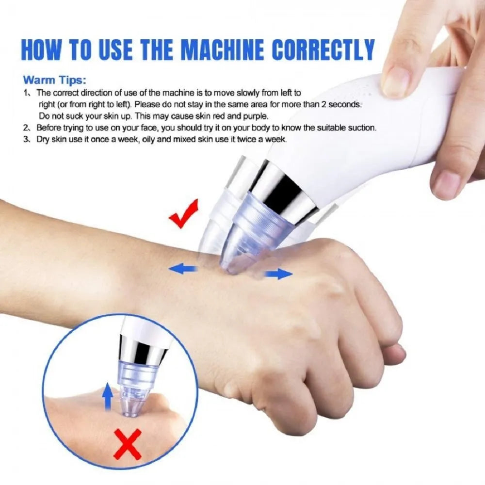 4 in 1 Derma Vacuum Suction Blackhead/Acne/Oil/Pore Cleaner 🌞💁♀️