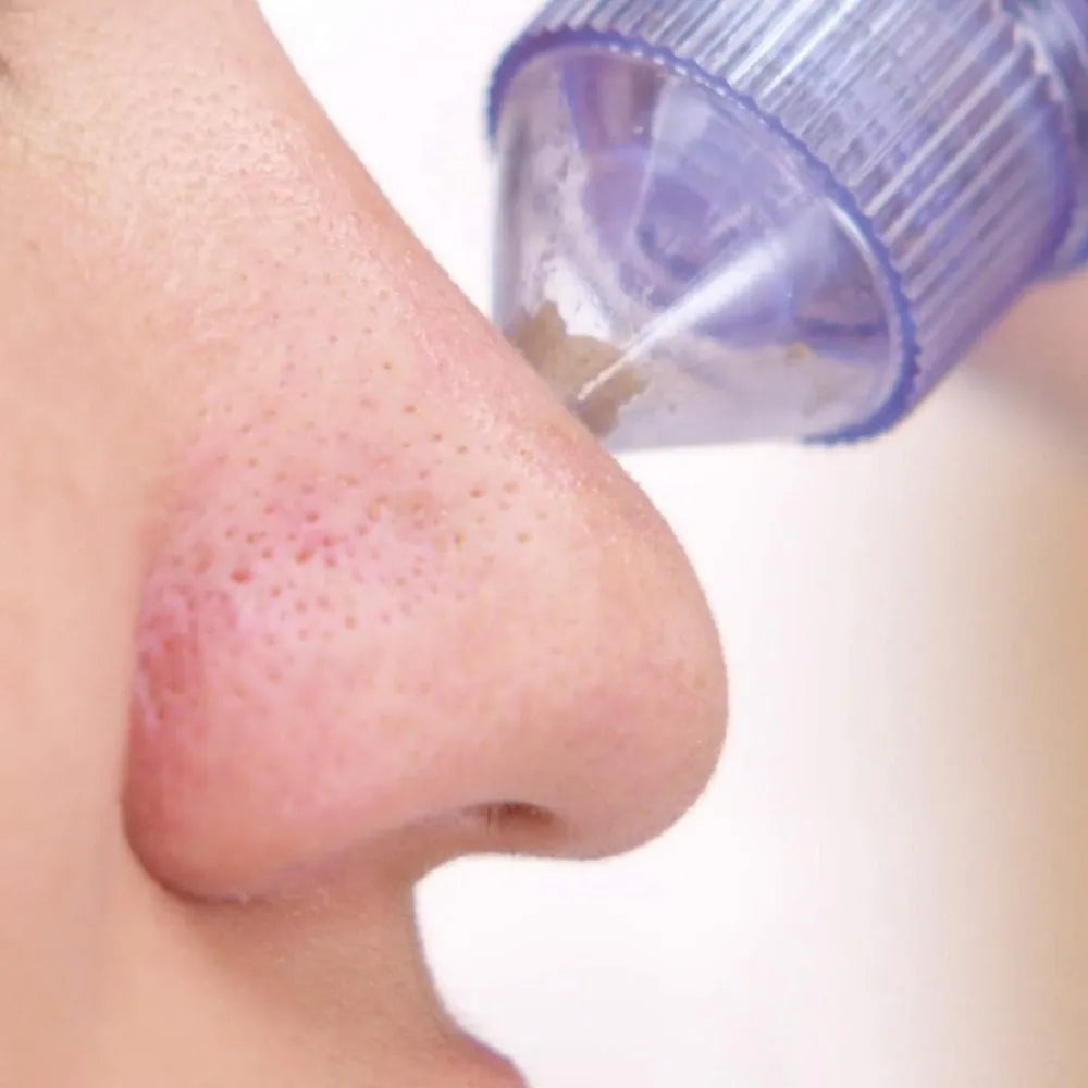 4 in 1 Derma Vacuum Suction Blackhead/Acne/Oil/Pore Cleaner 🌞💁♀️